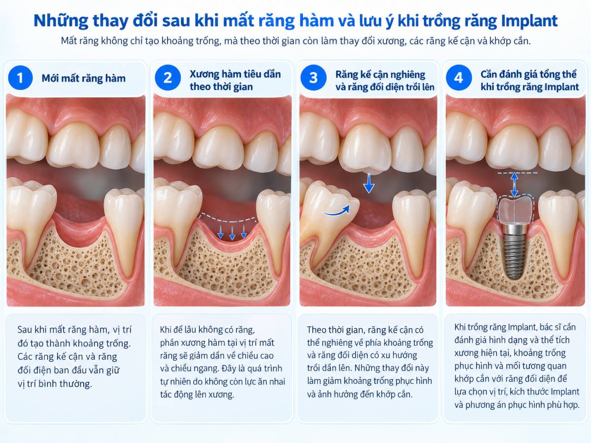 Các giai đoạn từ đánh giá đến phục hình Implant ở người mất răng lâu năm